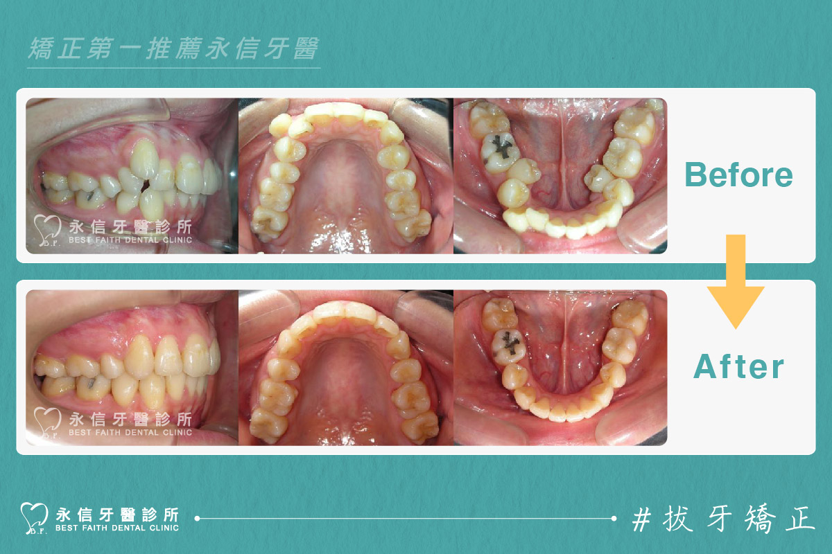 台中兒童牙齒矯正推薦